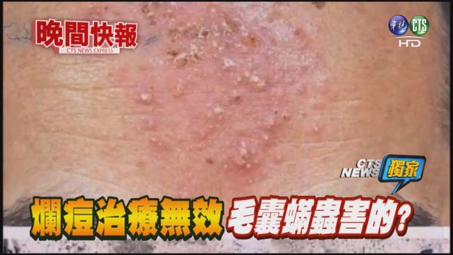 【晚間搶先報】獨!爛痘治療無效 毛囊蟎蟲害的? | 華視新聞