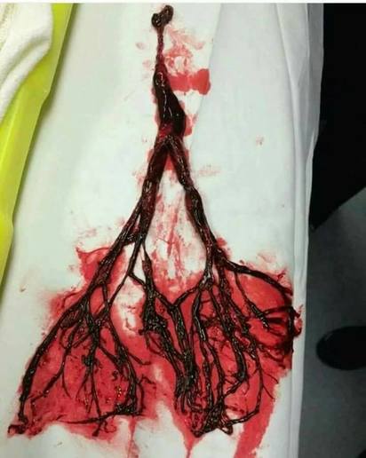 老翁鼻血流2天 插管抽出超恐怖「模型血塊!」 | 翻攝《臉書》「張志華」