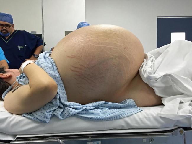 慎入! 女子肚藏31公斤囊腫 像塞進10個嬰兒 | 華視新聞