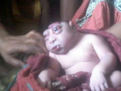 印度媽產畸型男嬰 村民認定猴神轉世 | 男嬰的腦部發展不健全。
