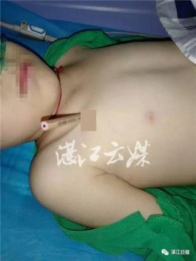 鉛筆刺胸口貫穿靜脈 男童險大失血死亡 | 華視新聞