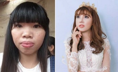 越南22歲女花43萬整型變正妹 閃嫁富二代 | 郭金鳳整型前後。