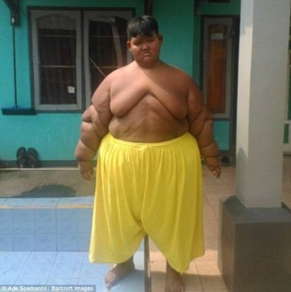 世界最胖男孩 190公斤被警告會”吃到胖死” | 進行手術後 男童立刻瘦了不少