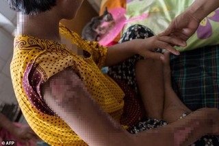 緬甸13歲女童工遭雇主拿熨斗燙 滿身傷送醫治療