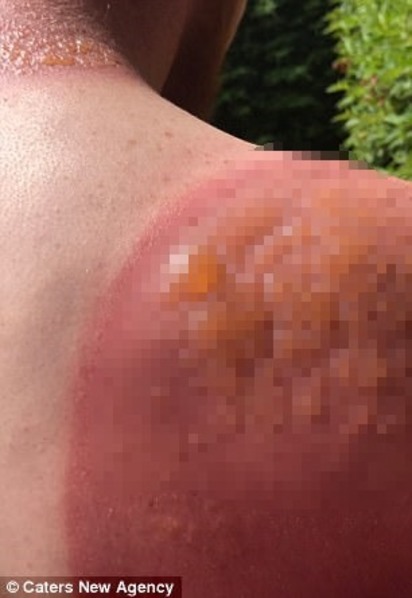 高溫烈日下工作7小時 英國園丁手臂二度灼傷 | 燙傷到起水泡。