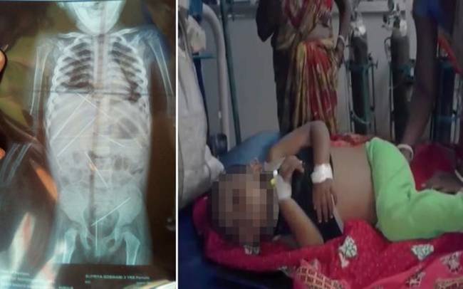 3歲女童慘當「巫毒娃娃」 身體插7針引發敗血症亡 | 華視新聞