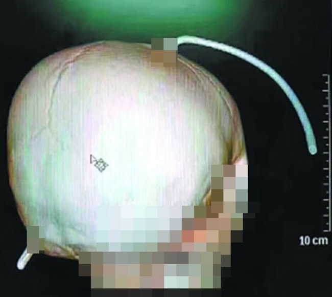 男童墜樓鋼筋穿腦 醫生:"這個"救了他 | 華視新聞
