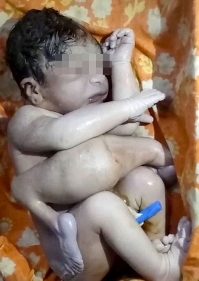 【影】孿生組織附著! 印度男嬰長7肢2生殖器 | 華視新聞