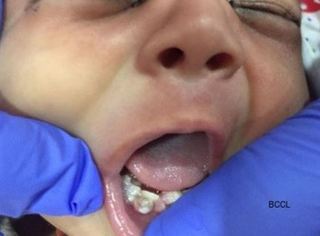 一出生七顆牙 醫生將寶寶"不牢牙"拔光