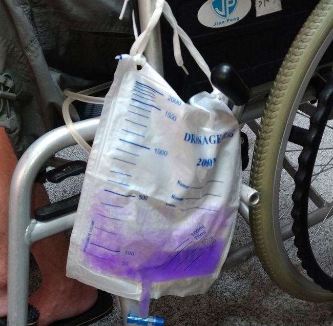 中風婦排"紫色尿液" 醫師:免疫力差警訊 | 華視新聞
