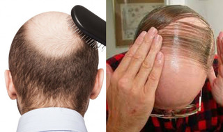 禿頭有救! 南韓最新實驗 老鼠毛髮"快速生長"