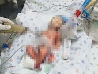 醫生誤判早產龍鳳胎夭折 送葬途中男嬰突復活