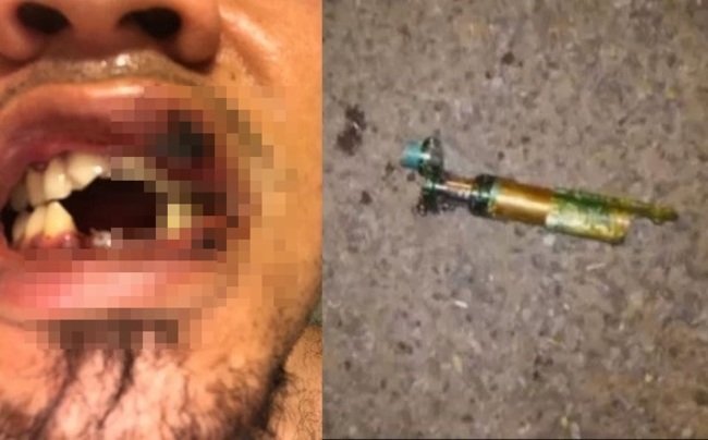 男抽電子菸爆炸 縫40針4顆牙遭炸飛 | 華視新聞