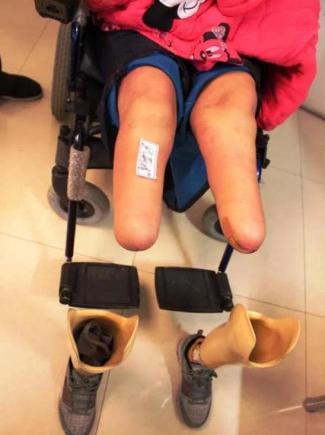 女高中生遭性侵遺棄凍傷 組織壞死雙腿截肢 | 華視新聞