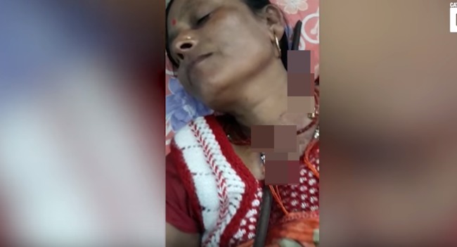 印度女遭鋼筋刺穿頸 醫生驚嘆"還好沒先拔出來" | 華視新聞