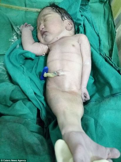 印度孕婦產下"人魚寶寶" 下半身黏在一起 | (翻攝每日郵報)
