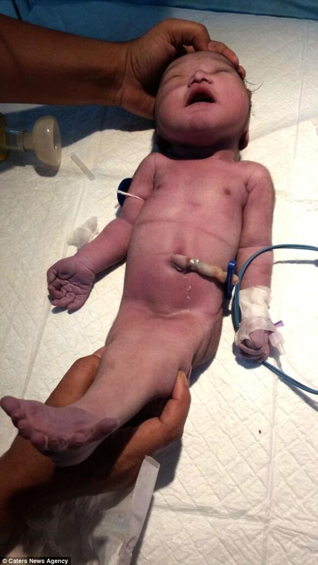 印度孕婦產下"人魚寶寶" 下半身黏在一起 | 華視新聞