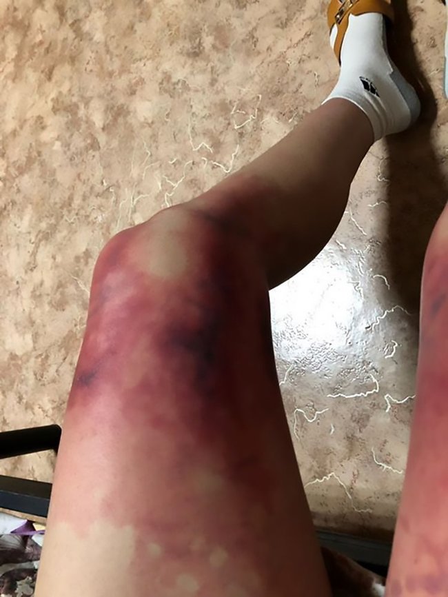 女大生-40℃穿超短裙出門 雙腿發紫"嚴重凍傷" | 華視新聞