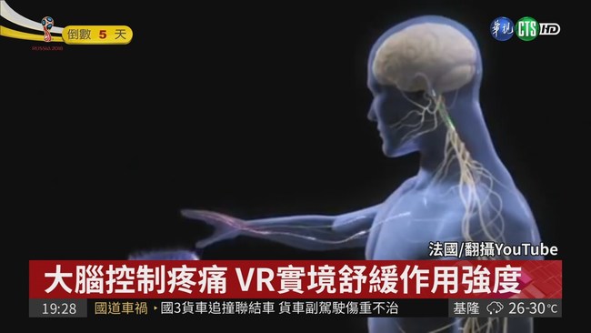 緩和病患情緒 戴VR頭盔降疼痛感 | 華視新聞