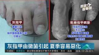 塗指甲油遮醜 腳跟痛竟罹患關節炎