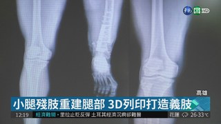 3D列印製義肢 身障移工重獲"膝"望