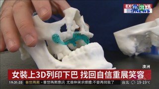 女罹癌切除上顎 裝3D列印下巴重生