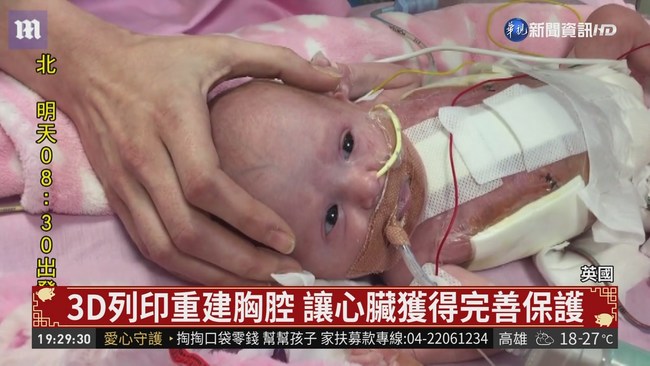 3D列印重建胸腔 "外心寶寶"獲准出院 | 華視新聞