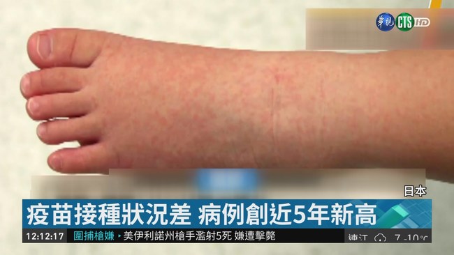 大阪麻疹增至46例 逾去年病例3倍 | 華視新聞