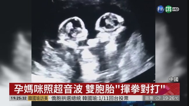 孕媽咪照超音波 雙胞胎"揮拳對打" | 華視新聞