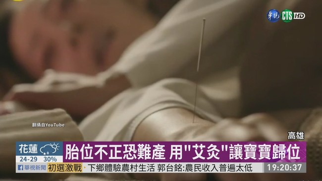 胎位不正免剖腹 靠"艾灸"讓寶寶歸位 | 華視新聞
