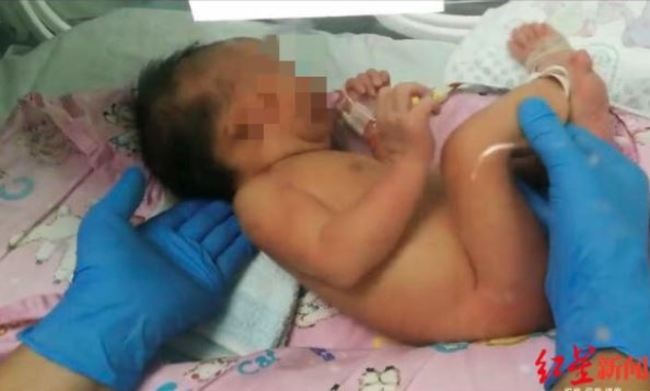 女嬰出生全身缺陷 產檢報告無異樣 | 華視新聞