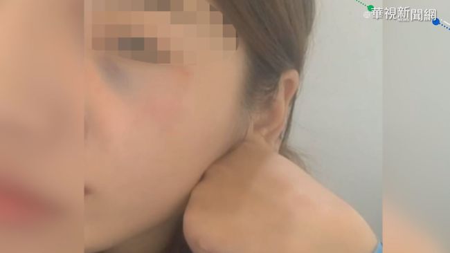 勸導行車糾紛 女警遭打傷眼瘀青 | 華視新聞