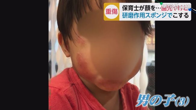 科技泡棉擦臉 日男童臉頰燒燙傷 | 華視新聞