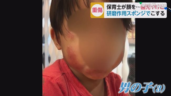 【台語新聞】科技泡棉擦臉 日男童臉頰燒燙傷 | 華視新聞