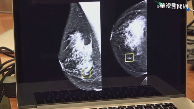 AI判讀乳癌X光片 準確度比醫生還高 | 華視新聞