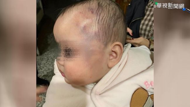 7月大女嬰臉大片瘀青 家長怒告保母 | 華視新聞