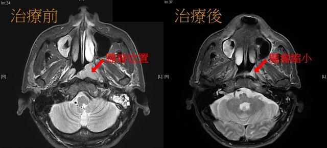 治療前的核磁共振影像，圖中顯示左側咽隱窩（fossa of Rosenmüller）長出1個約3公分大小的腫塊病灶。  右圖為接受完同步化學放射治療後追蹤的核磁共振影像，圖中顯示腫瘤明顯縮小。（北市聯醫提供）