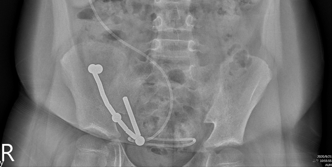 8歲男童腹痛多日求診 醫照X光驚：磁條、鐵珠黏一排 | 華視新聞