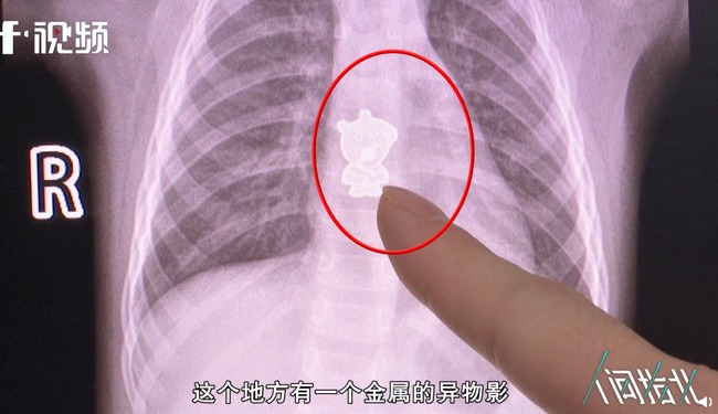中國女童起床後哭鬧不休 就醫檢查喉嚨卡「佩佩豬」 | 華視新聞