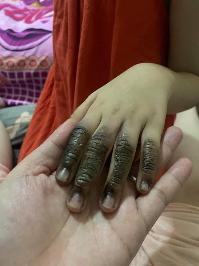 （當地母親分享家中７歲女童被插座觸電燒傷手指。／翻攝自臉書社團「爆廢公社公開版」）
