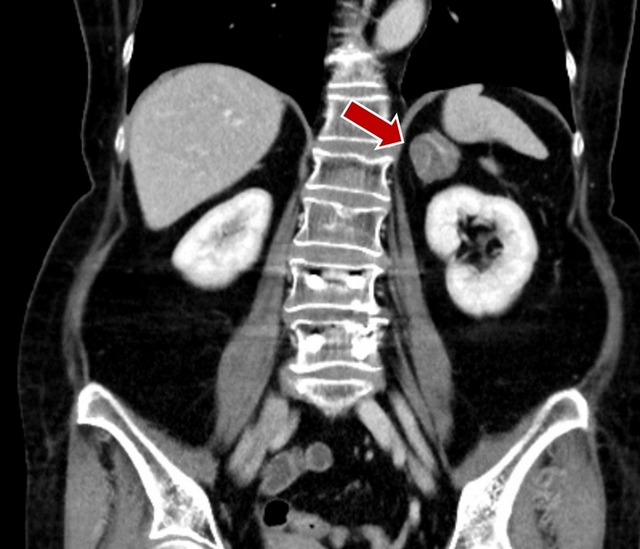 經電腦斷層檢查，發現張女士的右側腎上腺有顆3.6公分的腫瘤。（台北慈濟醫院提供）