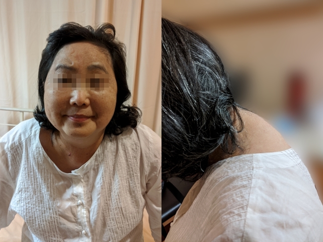 63歲婦人「變胖無力又高血壓」 竟罹罕見庫欣氏症 | 華視新聞
