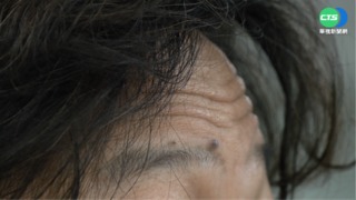 前額"皺紋多" 心血管疾病致命率恐飆10倍