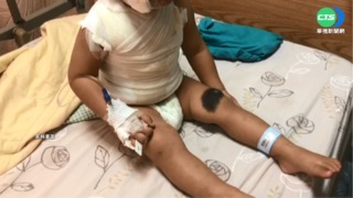 2歲童遭熱紅茶燙傷 警"開道"協助就醫