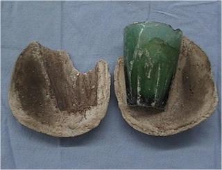 婦人為「情趣」玻璃杯塞下體 卡4年不敢就醫成巨大結石