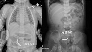 幼童嘔吐不止 X光體內驚現「這玩具」長庚醫：又來了