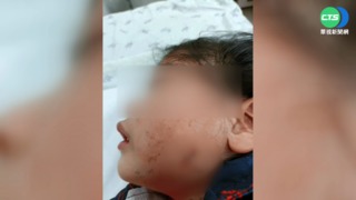 誰放狗咬人? 女童遭拖行20米雙頰縫8針