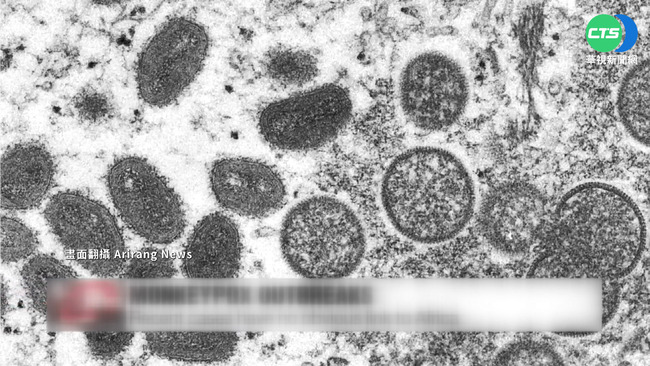 歐美猴痘病例逼近200人 世衛:病毒無變種 | 華視新聞