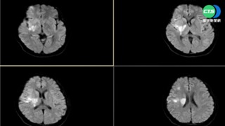 婦懷孕21周突中風 "局部麻醉手術"護嬰
