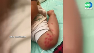 高美館兒童沙坑小黑蚊肆虐 童遭咬上百包